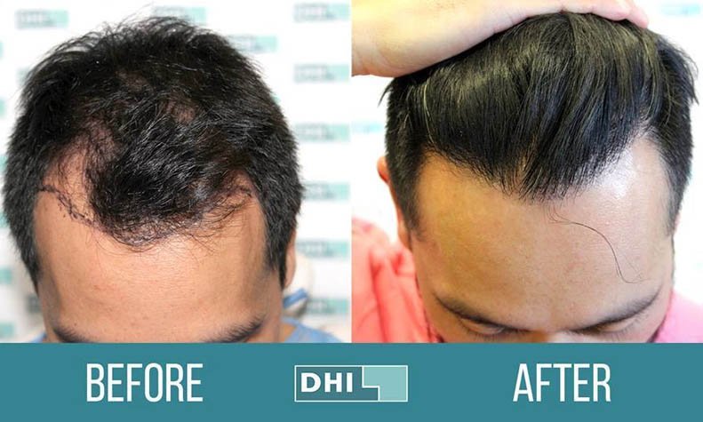 dhi-hair-transplant-clinic-gurgaon
