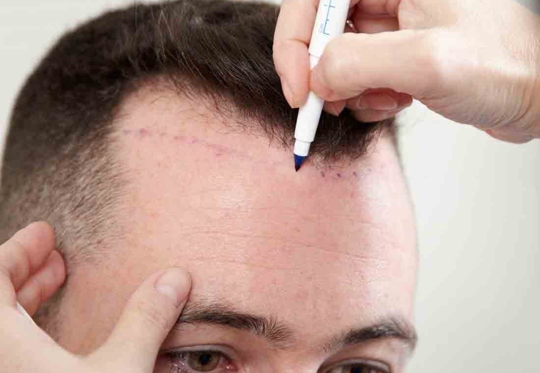 Best Hair Transplant Clinics In Gurgaon