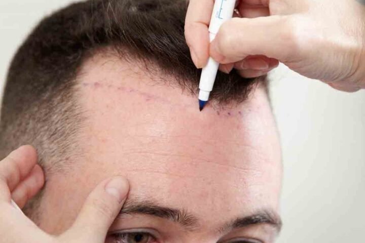 Best Hair Transplant Clinics In Gurgaon