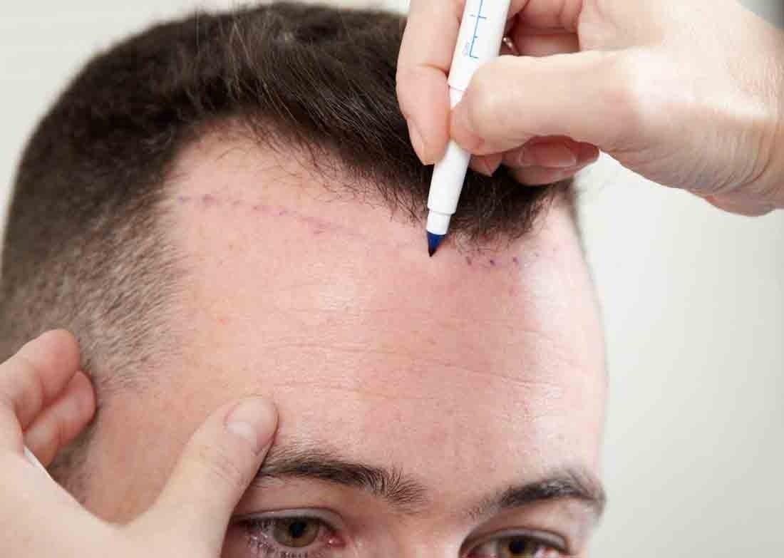 Best Hair Transplant Clinics In Gurgaon