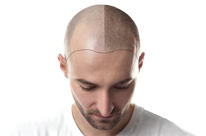 Is A Hair Transplant A Better Alternative Than Chemicals?