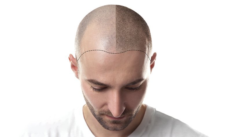 Is A Hair Transplant A Better Alternative Than Chemicals?